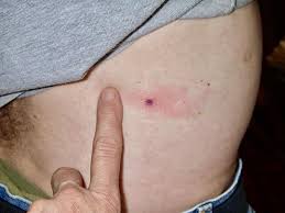 Image result for infected tick bite