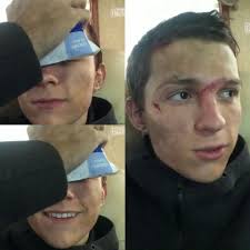 skymoonandstardust — Tom Holland and some of his injuries