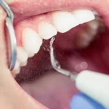 We did not find results for: Removal Of Calculus Dental Teeth Cleaning Treatment Melbourne