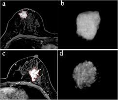 But not every woman who has been diagnosed with breast cancer needs a breast mri. Predicting The Response To Neoadjuvant Chemotherapy For Breast Cancer Wavelet Transforming Radiomics In Mri Bmc Cancer Full Text