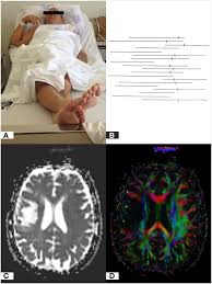 Image result for Crossed-Leg Test