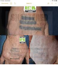 Usually, a few numbers of sessions are essential for removing a tattoo. Facebook