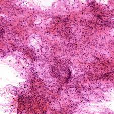 Phyllodes tumors are uncommon fibroepithelial breast tumors that are capable. Pathology Outlines Phyllodes Tumor