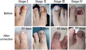 Image result for Paronychia feet