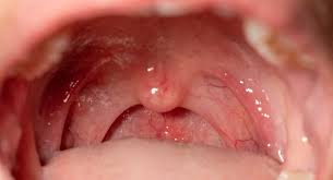 Image result for Physical injury red spots roof of mouth