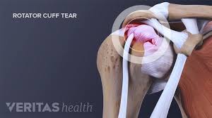 Image result for Rotator Cuff Injury