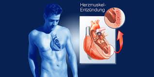 Many people who get myocarditis are otherwise. Jvpzq7rt1py5gm