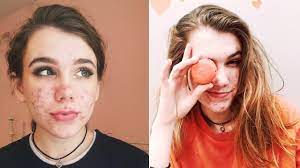 It will take approximately 5 days before doxycycline is eliminated from your system. Teen Says Acne Medication Doxycycline Led To Her Vision Loss Allure