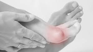 Hallux Rigidus Ursachen Behandlung Runner S World