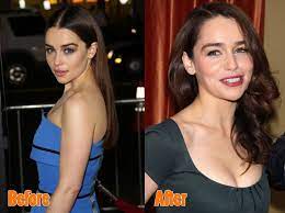 Pin On Plastic Surgery Before After