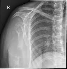 If your breast cancer has metastasized to your lungs, you may not notice any symptoms right away. Metastatic Breast Cancer Radiology Case Radiopaedia Org