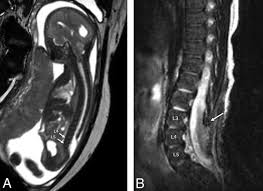 Image result for Dysraphism