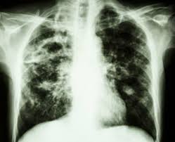 Our online radiology trivia quizzes can be adapted to suit your requirements for taking some of the top radiology quizzes. Who Coined The Term Tuberculosis Trivia Questions Quizzclub