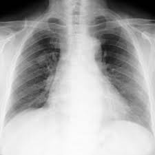 Therefore we suggest that no lesion should be missed in these patients without biopsy by assuming lung involvement of sarcoidosis. Pdf Sarcoidosis And Lung Cancer
