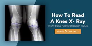 Image result for Knee XRay