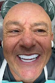 Does anyone experience ringing of the ears and “airplane ears/ barotrauma”  sensation? I am three weeks post op.