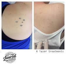 Lasers, dermabrasion, and other methods for tattoo removal. Lasertat Tattoo Removal Adelaide