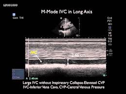 By focusing on a stepwise evaluation of the shock patient defined here as pump, tank, and pipes. How To Case Study Rush Exam Video Part 3 Sonosite Inc Youtube