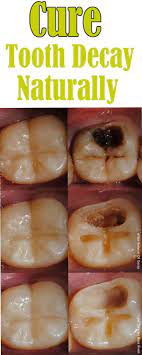 How To Heal Cavities Naturally Without Going To The Dentist Dentist Heal Cavities Dental Health Care Teeth Health