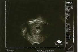 Schwangerschaft 6 Woche 6 Ssw Ultraschallbilder