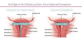Clomid can help hopeful parents achieve pregnancy. An Overview Of Iui Fertilityiq