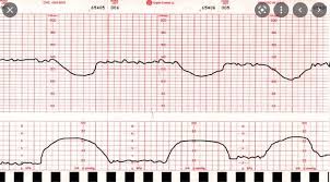 Image result for FHR Variability