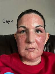 Swelling After Co2 Laser