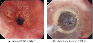 Cobblestone esophagitis (эзофагит со слизистой булыжной мостовой). Endoscopy For Diseases With Esophageal Dysphagia Intechopen