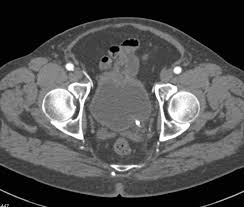 Find out what it is, how you have it and what happens afterwards. Enlarged Prostate Due To Prostate Cancer Genitourinary Case Studies Ctisus Ct Scanning