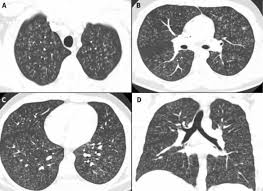 Trouvez ici une sélection de médecins spécialistes d'allemagne, d'autriche ou de suisse. Nouvelle Forme De Maladie Pulmonaire Liee Au Vapotage Detectee Au Canada Rci Francais