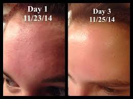 This Is My Story And It S Pretty Simple I Had Awful Bumps All Over My Forehead And Nothing Was Helping M In 2020 Forehead Acne Forehead Bumps Little Bumps On Forehead
