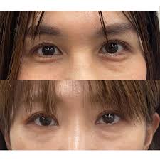 40代クマ取り物語】美容医療のプロがジャッジ！私のクマ、切るべきですか？ – STORY [ストーリィ] オフィシャルサイト