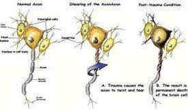 Cannabinoids As Alternative Treatment For Post Concussion Syndrome