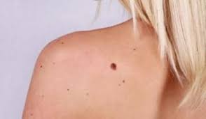 When prescribed as the first treatment, applying medication to the skin cancer helps to reduce the size of the cancerous tumor. Skin Cancer Treatment Advanced Dermatology Of The Midlands Omaha