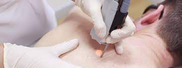 Everything You Need To Know About Laser Hair Removal Azure