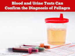 Pellagra - Causes, Symptoms, Diagnosis, Treatment And Complications