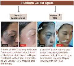 Can Nevus Of Ota Be Removed