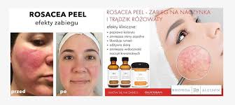 Peeling Medyczny Rhonda Allison