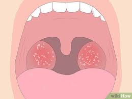 Image result for Strep throat infection roof of mouth