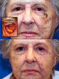 For the first 25 years of my skin cancer, treatments consisted of cryosurgery on areas of actinic keratosis, some laser surgery for precancerous areas and basal cell areas, and excisional surgery for removal of basal cell carcinomas and squamous cell carcinomas. 1p2d1f00x Hwlm