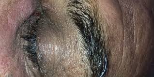 For that, you have to wash your face with an exfoliating face cleaner and make circular motions insisting on the affected area the most. Doctor Extracts Deep Blackheads Under The Eyes Videos Insider