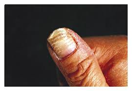 Image result for Beau lines feet