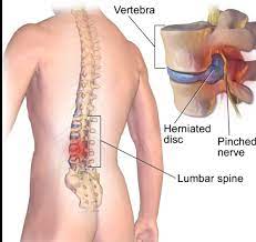 Herbal treatment of slip disc by natural herbs is given in repertory format. Slip Disc Physiotherapy In Gurgaon Best Slip Disc Treatment