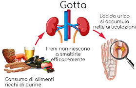 Anatra, frutti di mare e uova di pesce, insaccati grassi, formaggi stagionati grassi, strutto, lardo, alcol. Artrite Gottosa Cause Sintomi Alimentazione E Cura