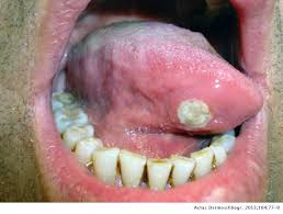 Browse 10,427 human tongue stock photos and images available, or search for sticking out tongue or mouth open to find more great stock photos and pictures. Painful Tongue Ulcers Actas Dermo Sifiliograficas