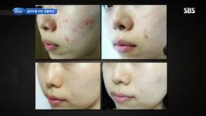 Cold Plasma and the Plabeau G4+: Terri Vinson Waves Her Magic Wand