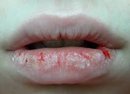 Jika ia disebabkan oleh jangkitan kulat, doktor boleh menetapkan krim atau salap. Punca Sebenar Bibir Kering Bukan Kerana Kurang Minum Air Masak Sebenarnya
