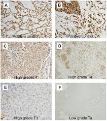 Bladder cancer has been linked to smoking, parasitic infections, radiation, and chemical exposure. Association Of Aromatase With Bladder Cancer Stage And Long Term Survival New Insights Into The Hormonal Paradigm In Bladder Cancer Clinical Genitourinary Cancer