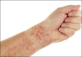 Most causes are temporary and will resolve without treatment, but serious cases do need treatments! Low Platelet Count Natural Treatment Thrombocytopenia Ayurvedic Treatment Dr Vikram S Blog Ayurvedic And Herbal Remedies
