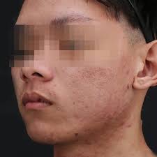 Oily & Acne (For Men)